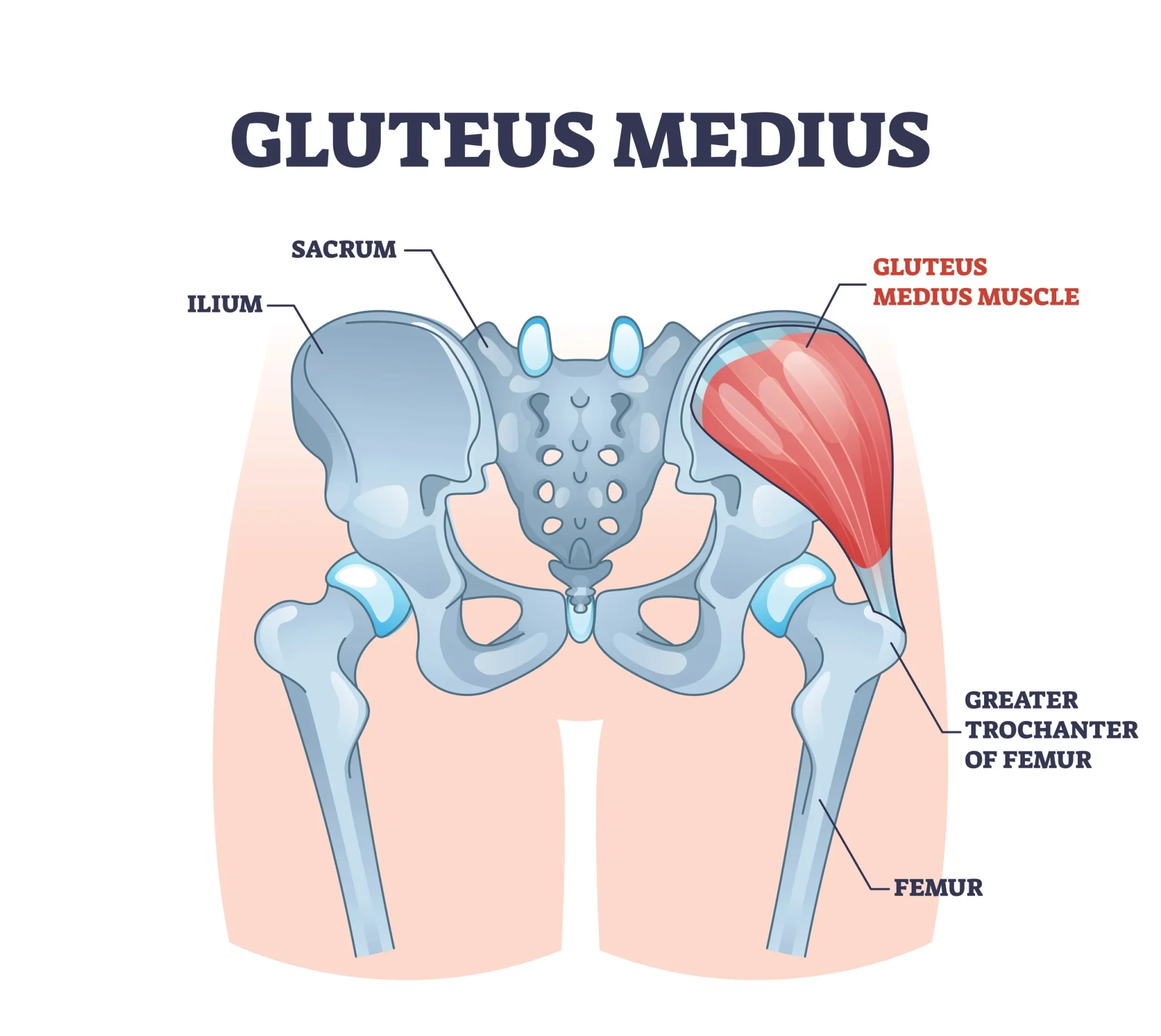 Gluteus Medius Tear Treatment In Columbus OH OrthoNeuro